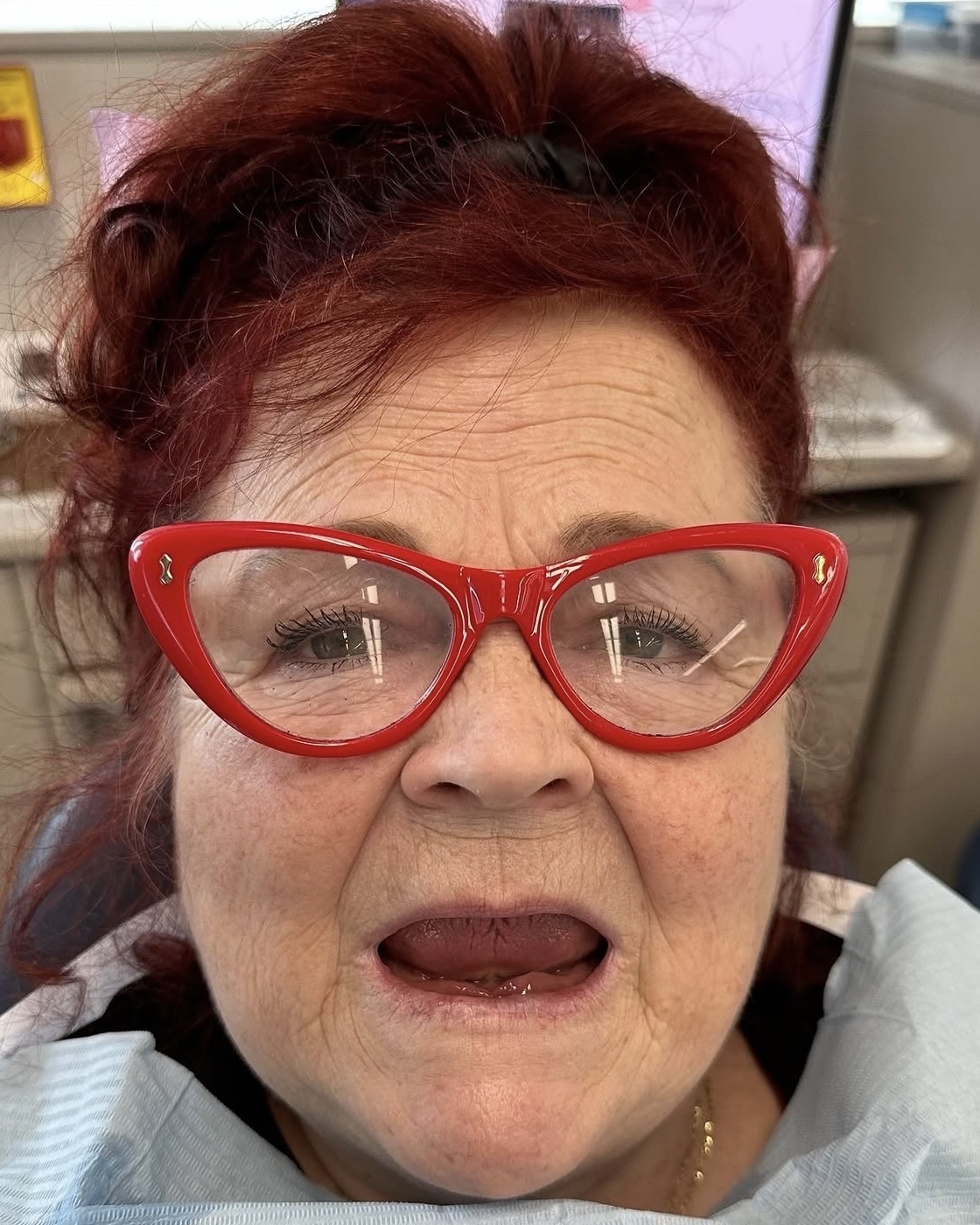 The patient before treatment, with no upper teeth visible