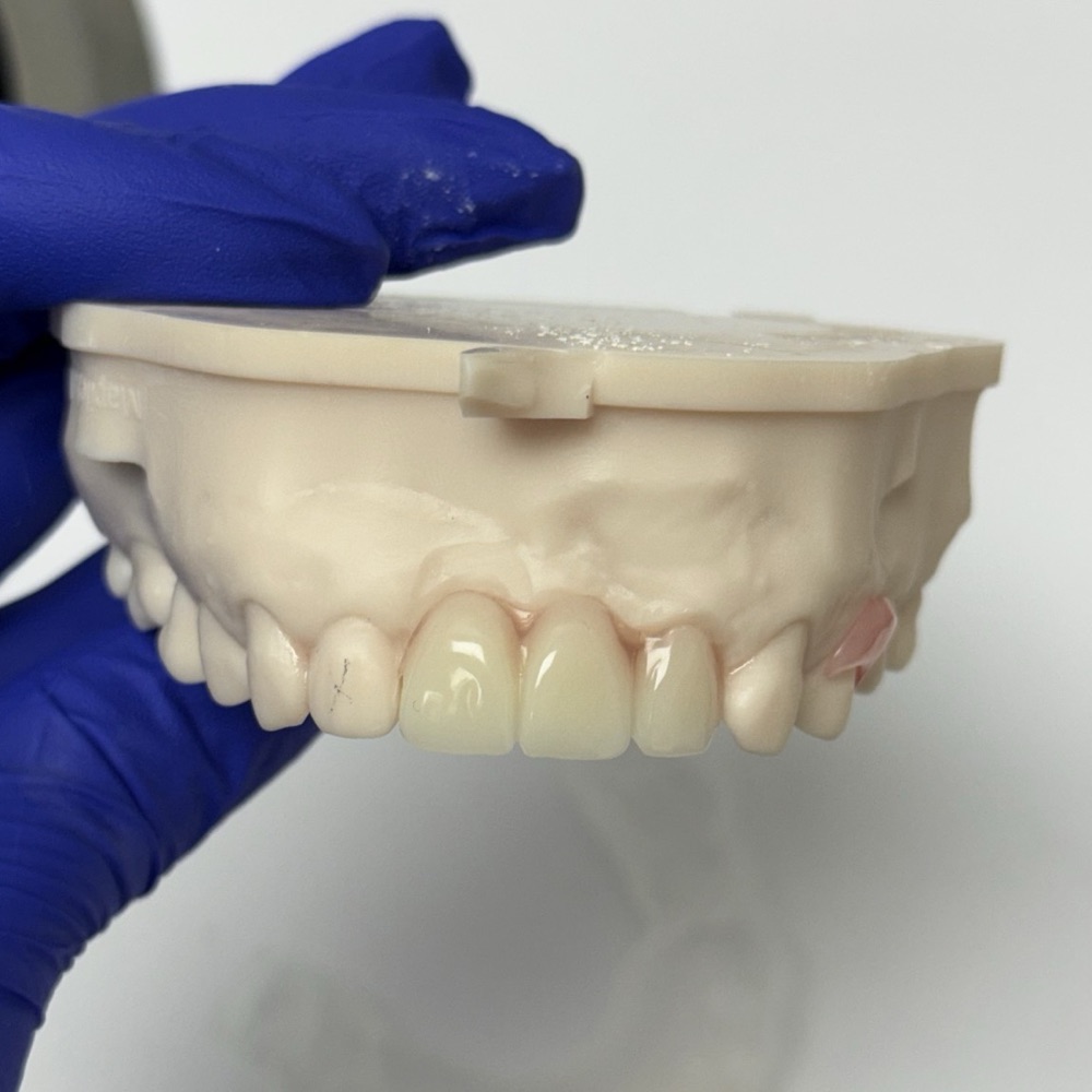 A denture setup checked on the articulator before it is finished